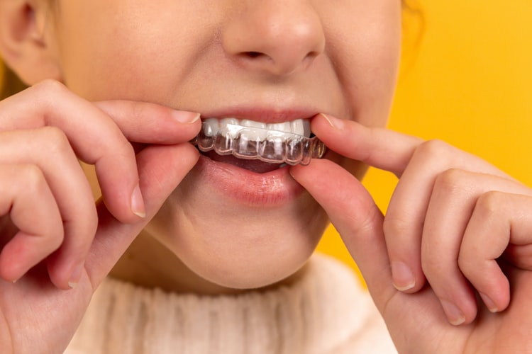 clear aligners 6