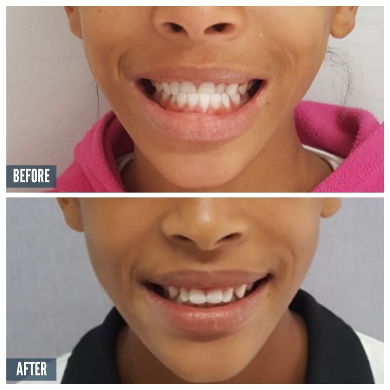 BA 2 Braces 2